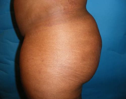 Brazilian Butt Lift After, Female 39 - 3058