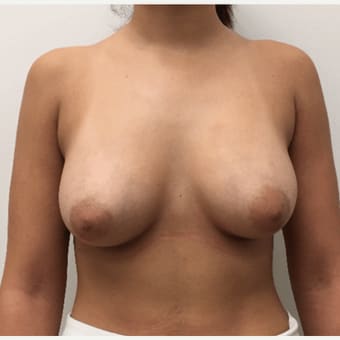 Breast Augmentation with Implants After, Female 33 - 1663