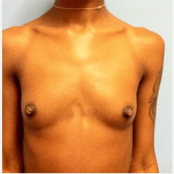 Breast Augmentation with Implants Before, Female 22 - 1662