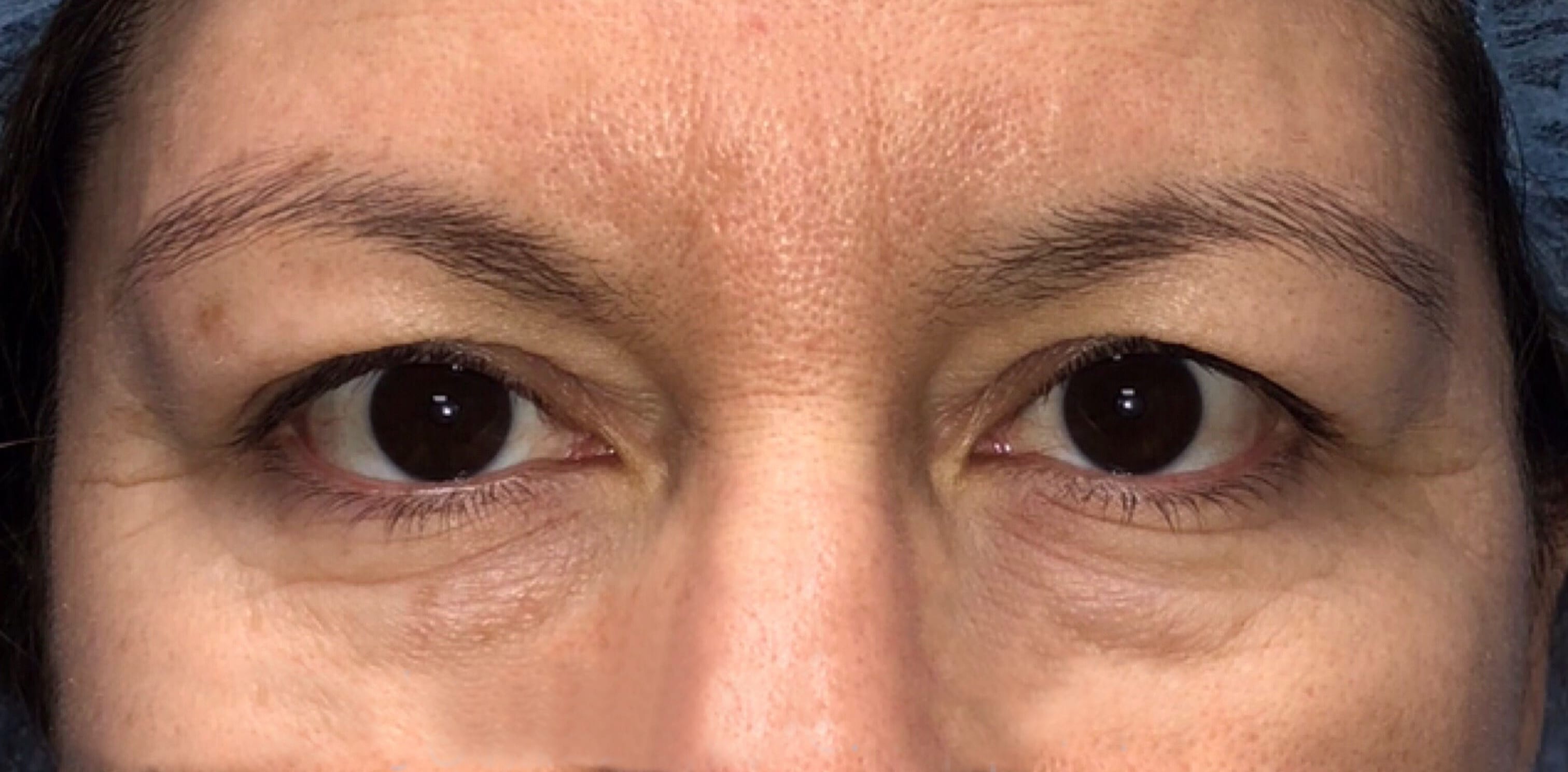 Blepharoplasty Before, Female 45 - 110