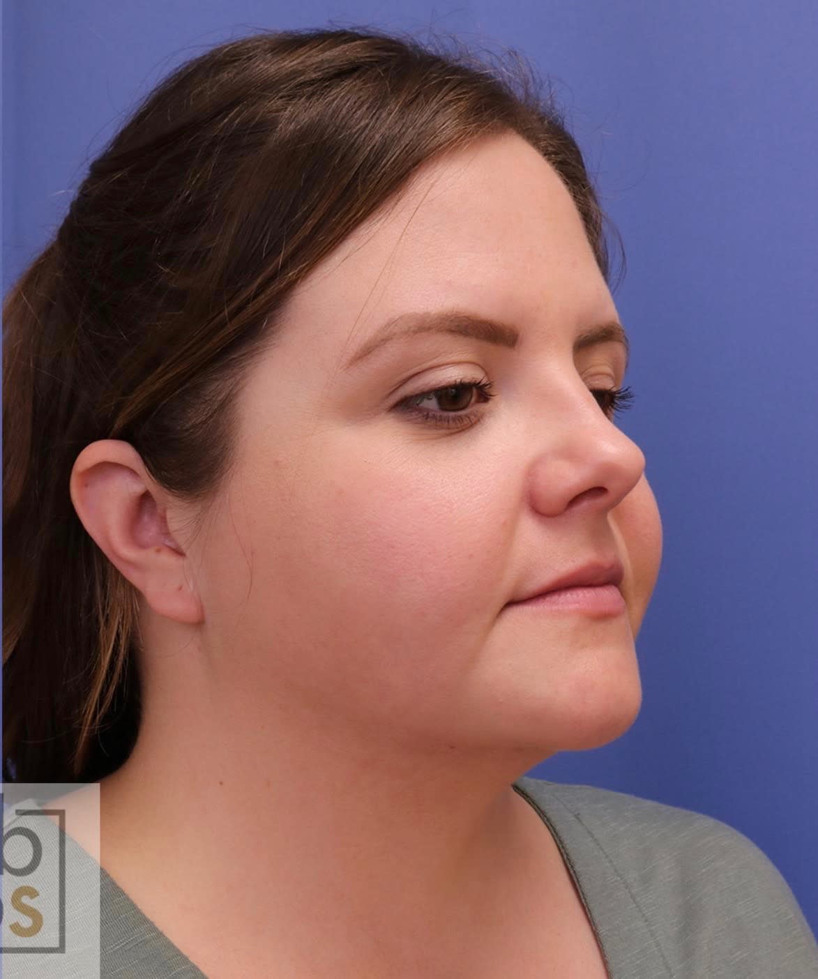 Chin Reduction After, Female 28 - 1958