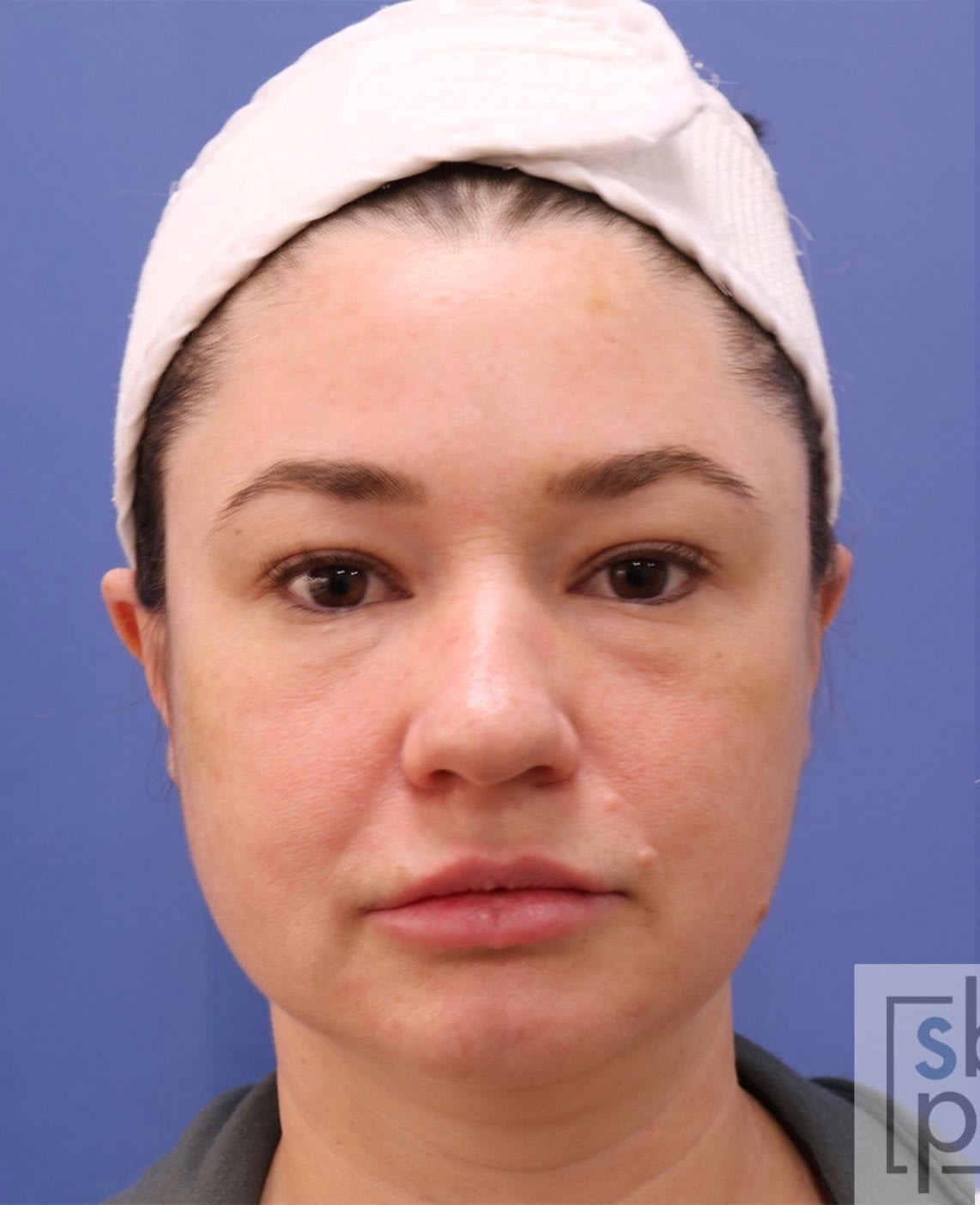 Chin Reduction Before, Female 30 - 1957