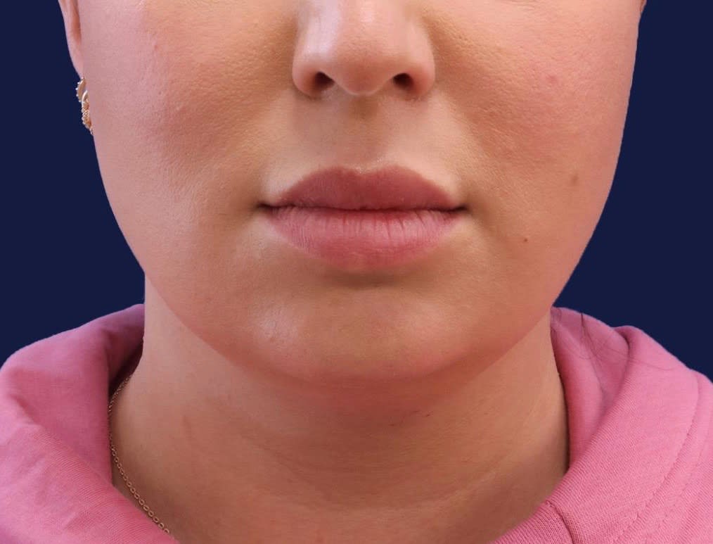 Chin Reduction Before, Female 34 - 1955