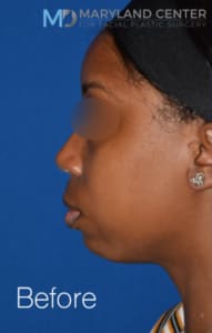 Chin Enhancement Solutions Before, Female 33 - 1850