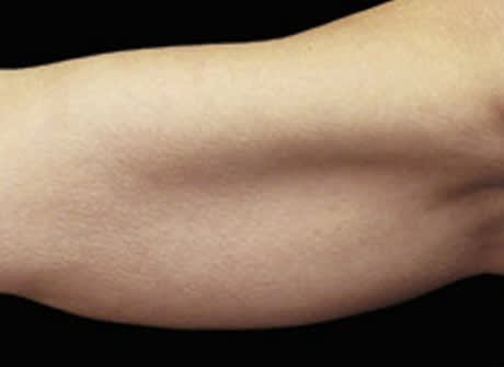 CoolSculpting® Before, Female 40 - 4853