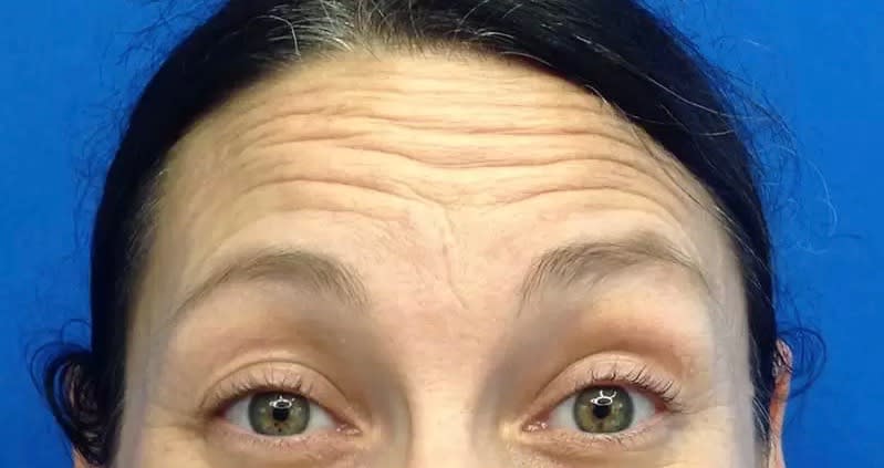 Botox Before, Female 35 - 2835