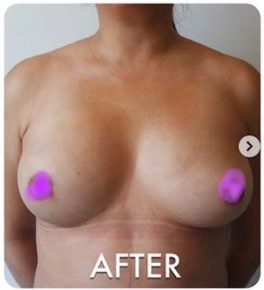 Breast Augmentation with Fat Transfer After, Female 31 - 1724