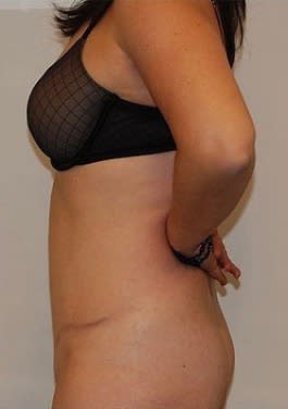 Tummy Tuck (Abdominoplasty) After, Female 44 - 1721