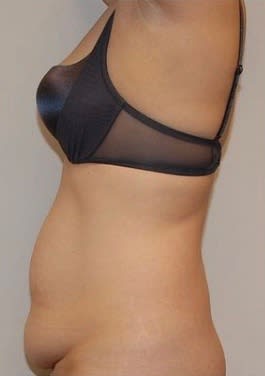 Tummy Tuck (Abdominoplasty) Before, Female 44 - 1721