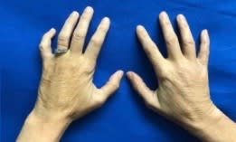 Hand Rejuvenation with Dermal Fillers Before, Female 60 - 2844