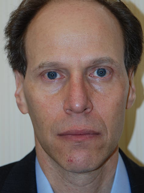 Blepharoplasty After, Male 45 - 16