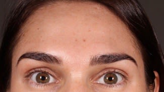 Botox After, Female 29 - 2341