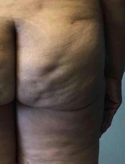 Cellulite Removal Before, Female 35 - 2346