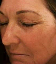 Skin Resurfacing Solutions After, Female 50 - 2340