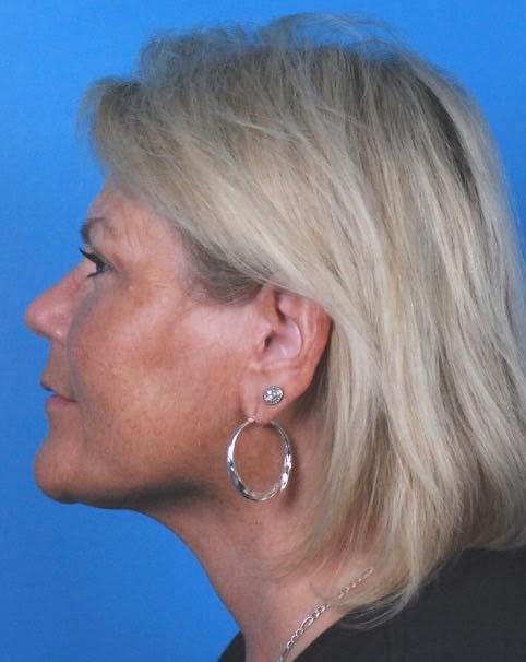 Facelift After, Female 53 - 2330