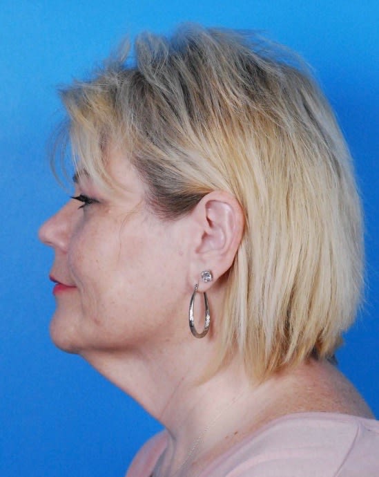 Facelift Before, Female 53 - 2330
