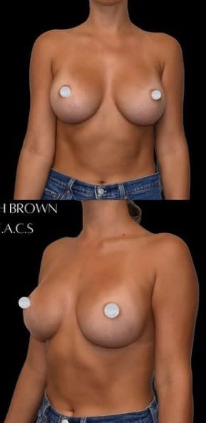 Breast Augmentation (Augmentation Mammaplasty) After, Female 27 - 2059