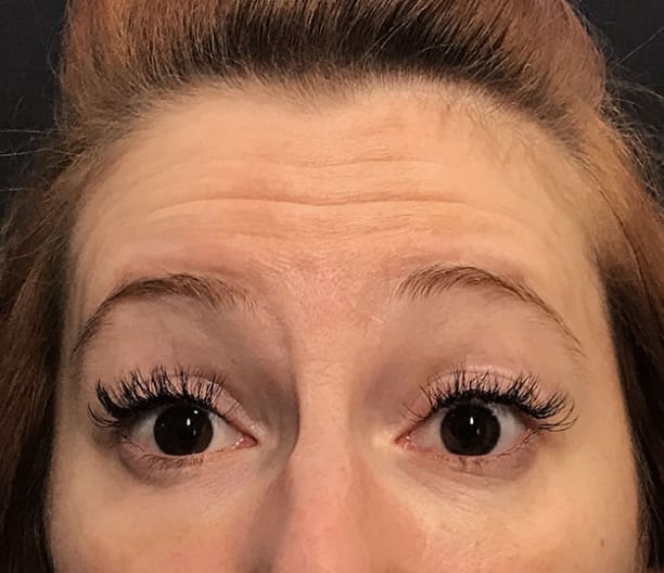 Botox Before, Female 35 - 3599