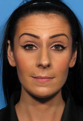 Botox Before, Female 3 - 2345
