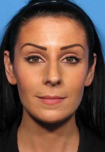 Botox After, Female 3 - 2345