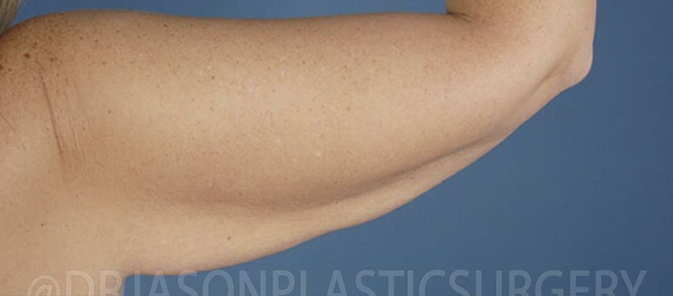 Arm Lift Before, Female 35 - 395