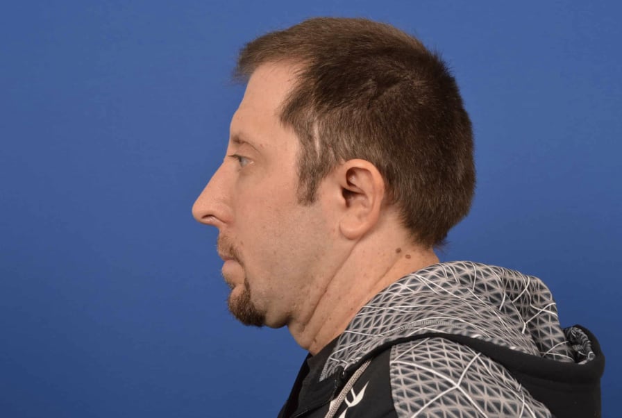 Rhinoplasty After, Male 46 - 4837