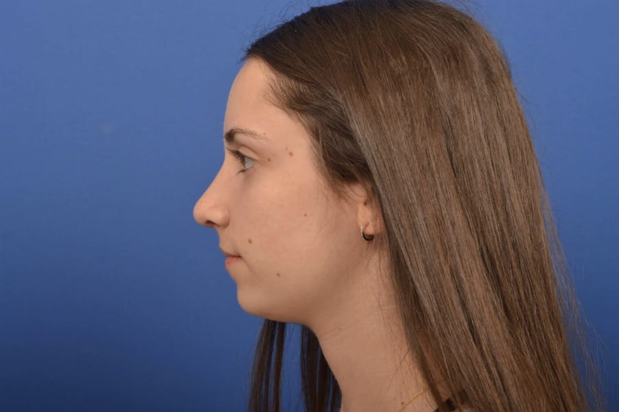 Rhinoplasty After, Female 18 - 4838