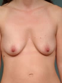 Breast Augmentation with Implants Before, Female 42 - 4657