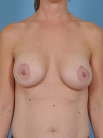 Breast Augmentation with Implants After, Female 37 - 4659
