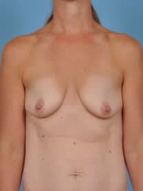 Breast Augmentation with Implants Before, Female 37 - 4659