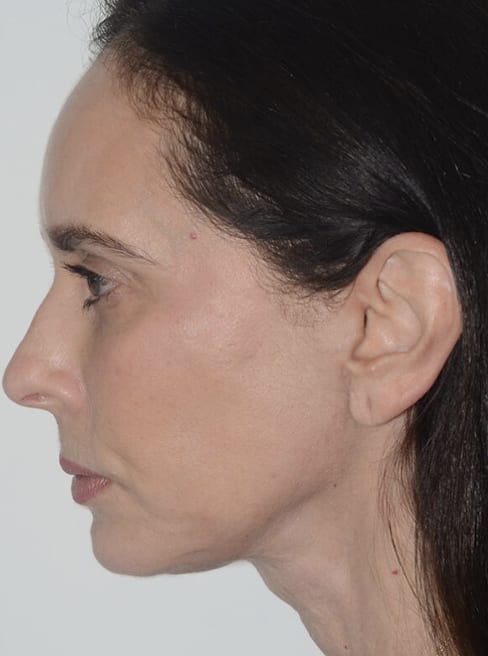 Facelift After, Female 55 - 4755
