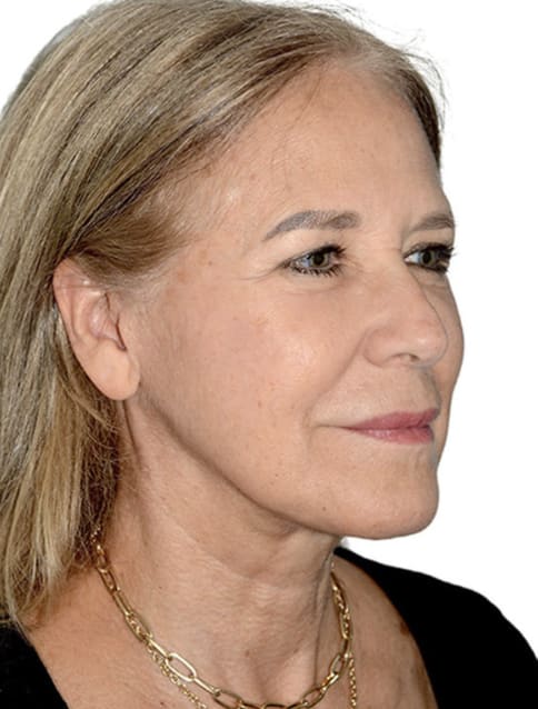 Facelift After, Female 63 - 4757