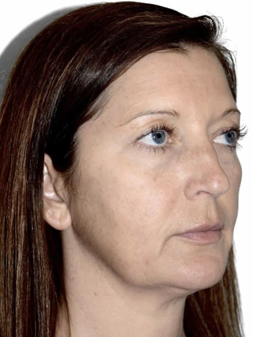 Facelift Before, Female 45 - 4759