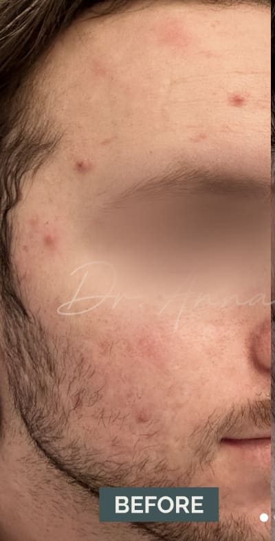 Acne Treatment Before, Male 32 - 4827