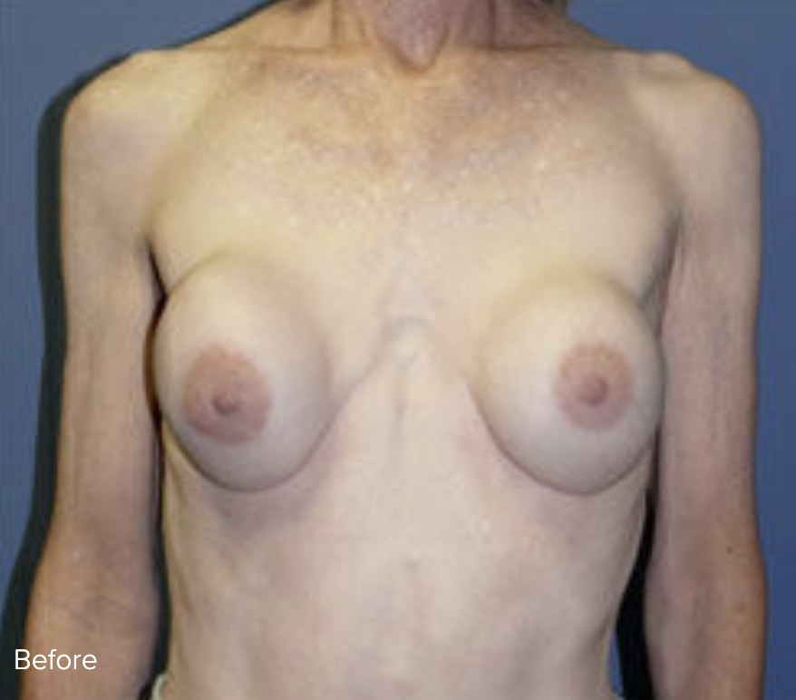 Breast Augmentation Solutions Before, Female 32 - 4819