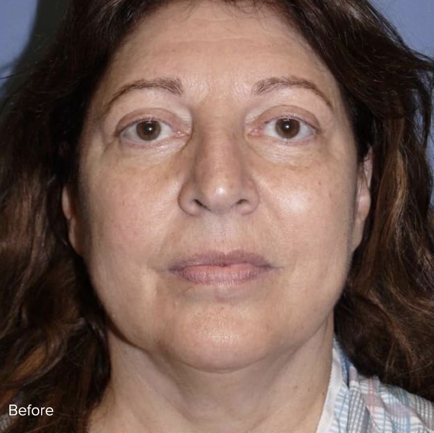 Facelift Before, Female 54 - 4809