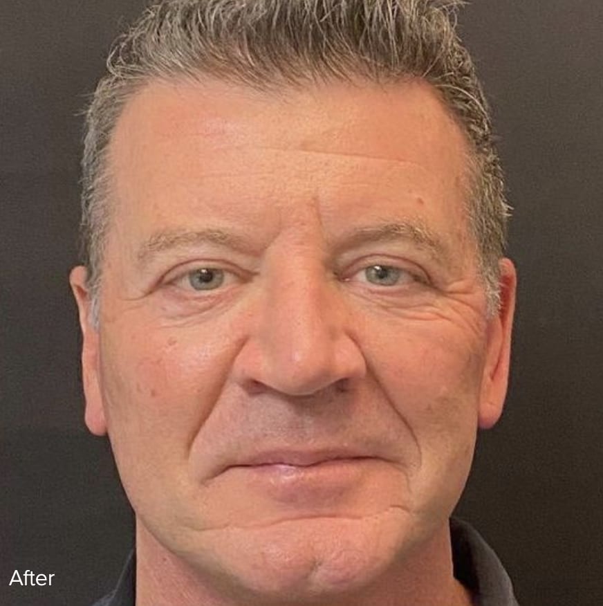 Facelift After, Male 52 - 4810