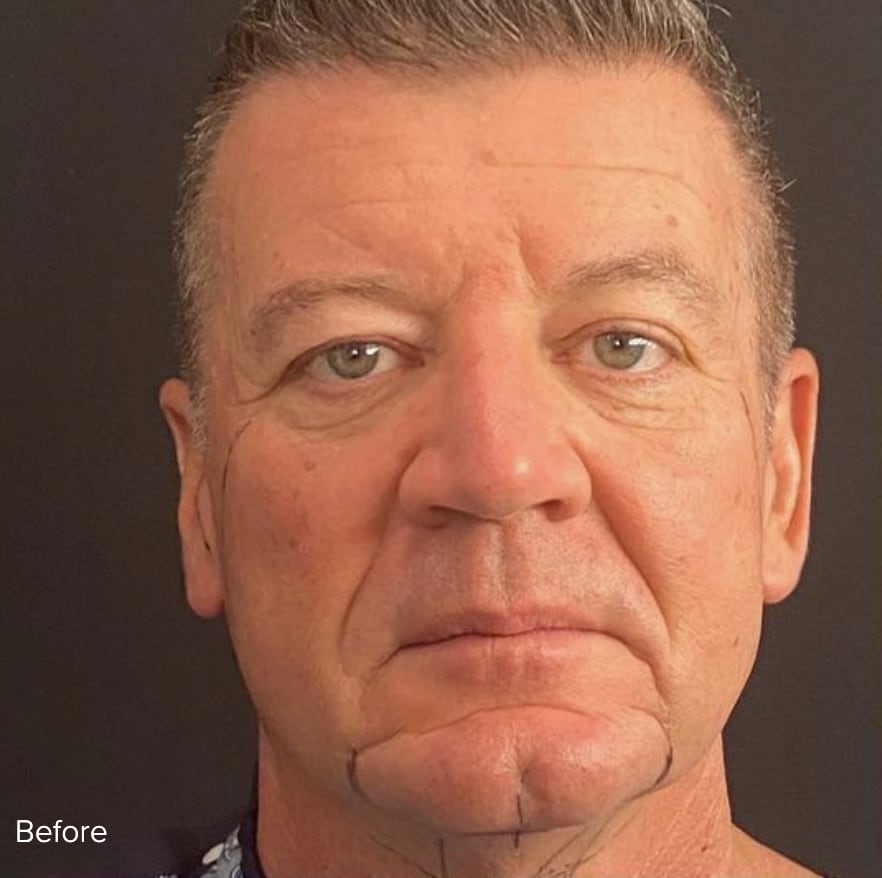 Facelift Before, Male 52 - 4810