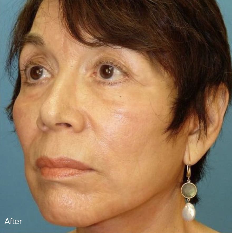 Facelift After, Female 56 - 4811