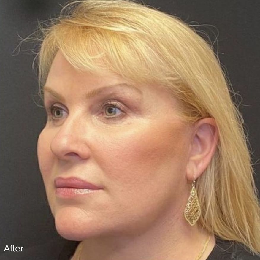 Facelift After, Female 48 - 4812