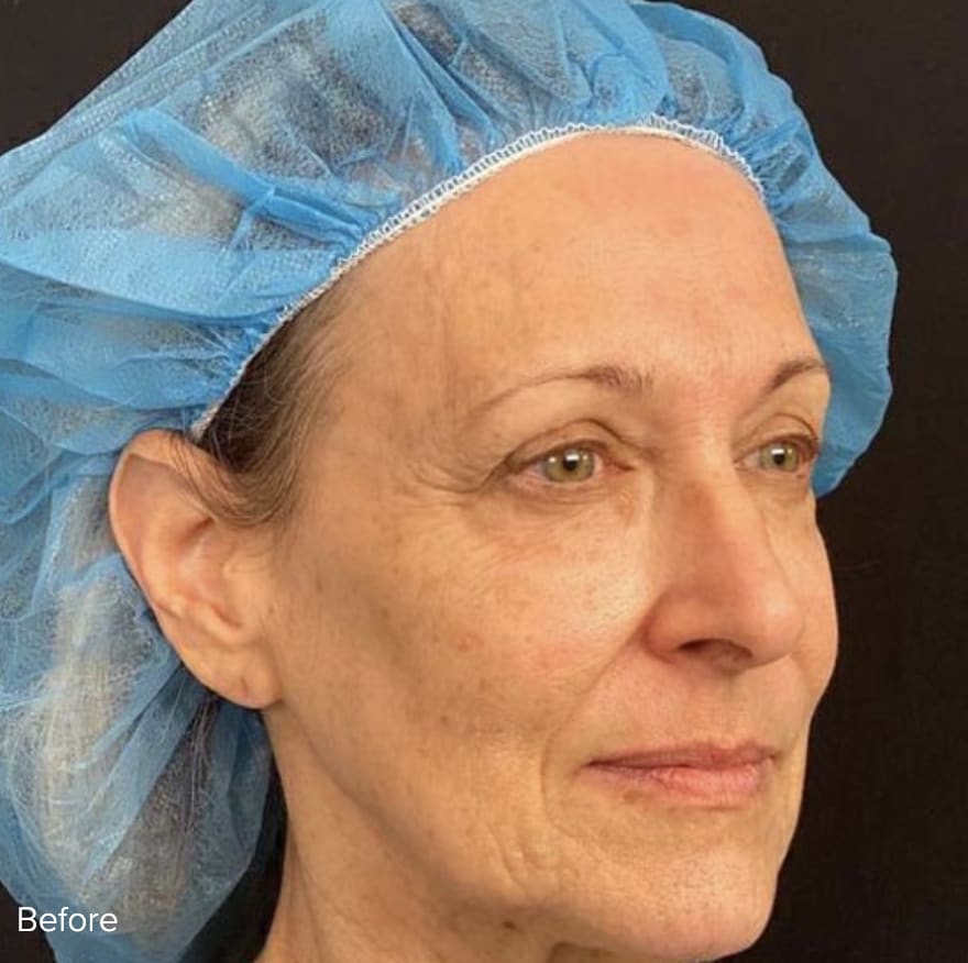 Facelift Before, Female 53 - 4813