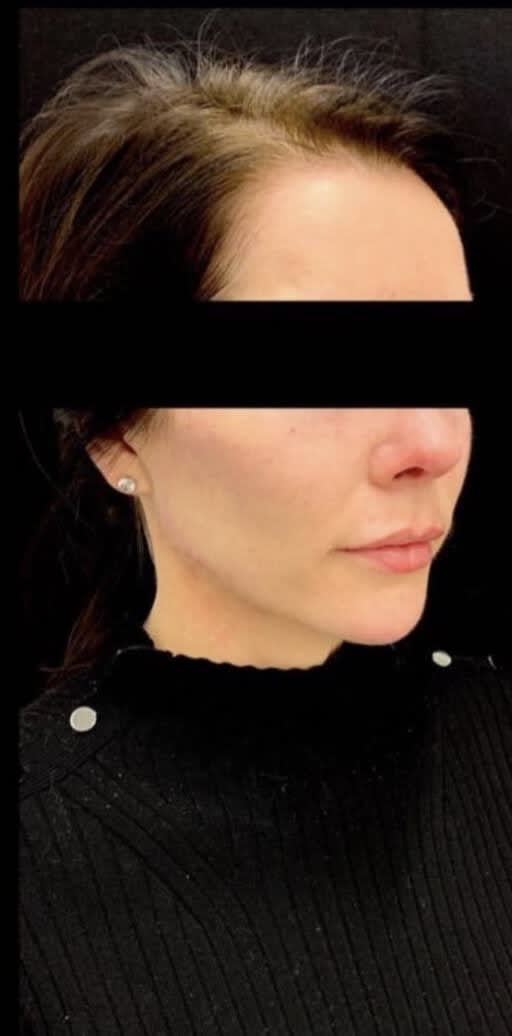 Buccal Fat Removal After, Female 35 - 4645