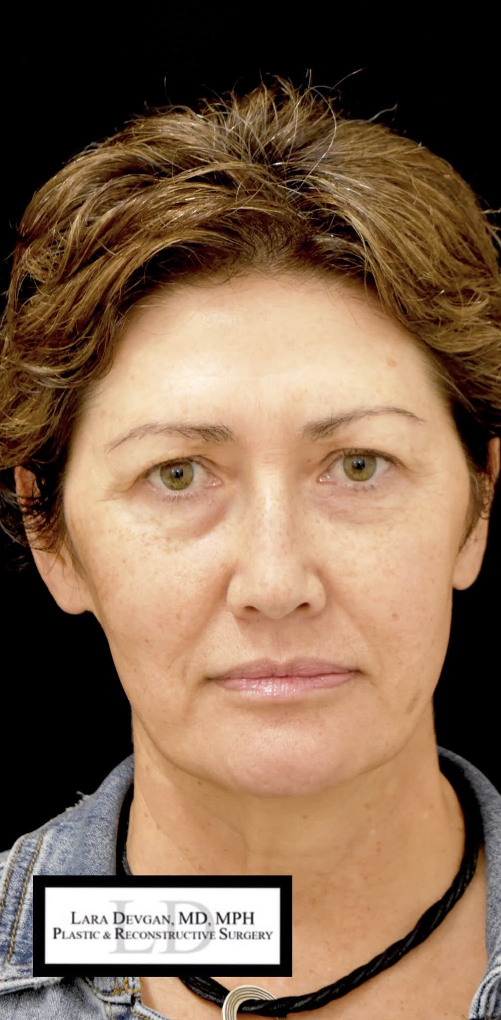 Blepharoplasty Before, Female 42 - 4637