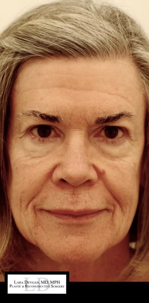 Blepharoplasty Before, Female 67 - 4638