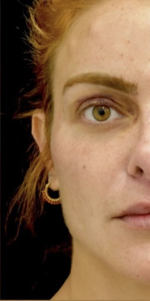 Blepharoplasty After, Female 34 - 4639