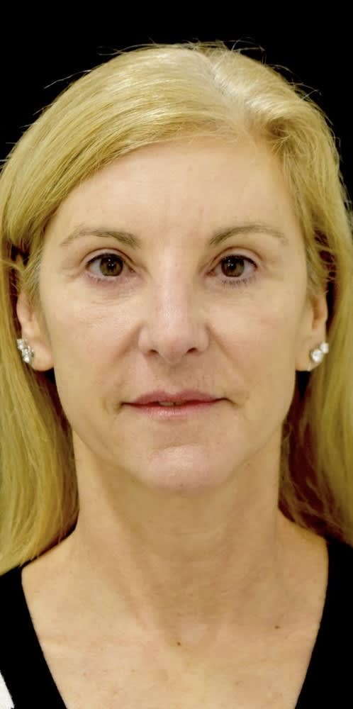Blepharoplasty After, Female 54 - 4641