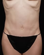 Abdominoplasty After, Female 28 - 4683