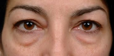 Blepharoplasty Before, Female 48 - 4689