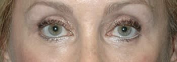 Blepharoplasty After, Female 60 - 4610
