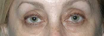 Blepharoplasty Before, Female 60 - 4610